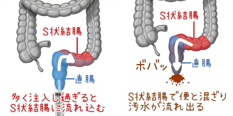 直腸の洗浄で、注入する液体が多すぎると、セッションに影響が出る画像